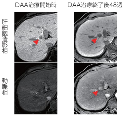 DAA治療前に検出されたNHHNの多血化