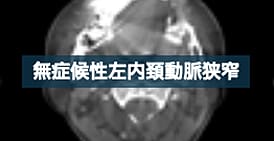 iMAR及び低管電圧撮影，ADMIREを併用した頸動脈CTA１症例