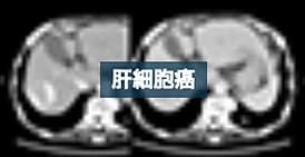 腫瘍内の仮性動脈瘤が明瞭に描出された肝細胞癌の一例