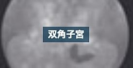 双角子宮