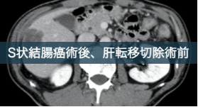 S状結腸癌術後, 肝転移の術前診断におけるEOB-MRIの有用性
