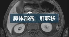 膵癌、EOB-MRIによる肝転移検索の重要性
