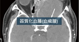 ダイナミック造影CTによる上顎洞器質化血腫（血瘤腫）の血流評価