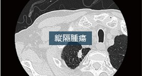 ダイナミック造影CTによる縦隔腫瘍の鑑別診断・血管浸潤の評価