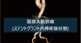 腹部大動脈瘤ステントグラフト内挿術後のエンドリーク症例