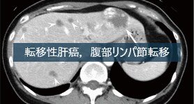 造影CTによる右乳癌治療後の遠隔転移評価