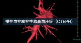 Dual Energy CTを用いた慢性血栓塞栓性肺高血圧症の評価