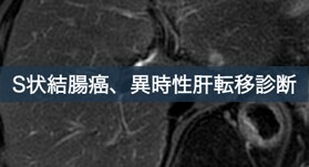 S状結腸癌、異時性肝転移診断におけるEOB-MRIの有用性