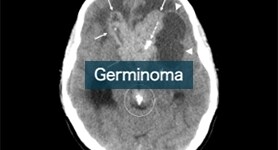 Germinoma
