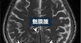 上矢状静脈洞浸潤を伴った傍矢状 部髄膜腫