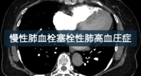 肺動脈バルーン形成術により血流 の改善を認めた慢性肺血栓塞栓性 肺高血圧症の1例