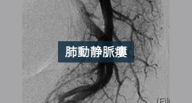 肺動静脈瘻コイル塞栓術後TBT 法を用いた肺動静脈分離