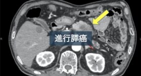 Dynamic CTによる膵癌の1例