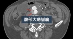 EVAR後 TypeIIendoleakの1例