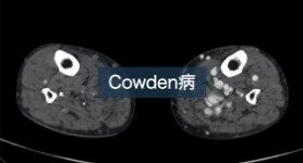 下肢動静脈奇形を伴うCowden 病の1例