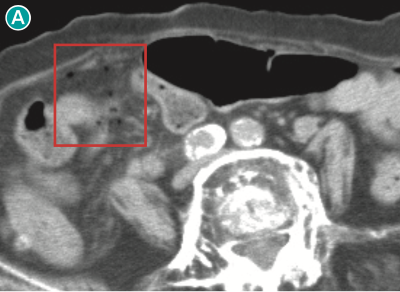 図 nonsurgical pneumoperitoneumの一例(単純CT,脂肪条件)