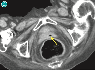 図 nonsurgical pneumoperitoneumの一例(単純CT,脂肪条件)