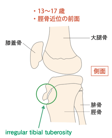 図1 irregular tibial tuberosity