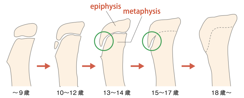 図3 脛骨近位においてepiphysisとmetaphysisが骨化していく過程