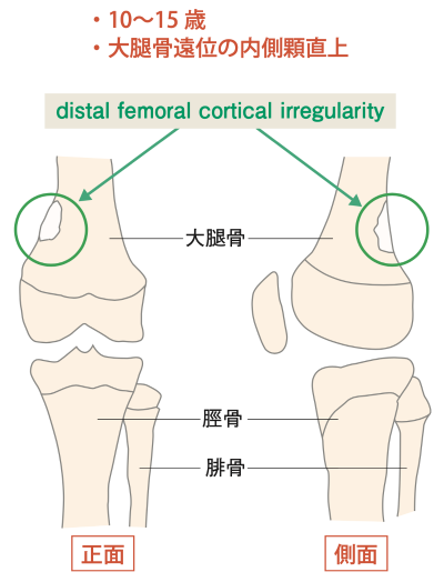 図4 distal femoral cortical irregularity(corical desmoid)