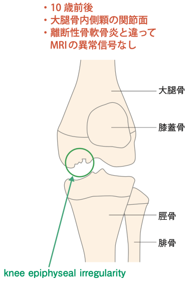図5 knee epiphyseal irregularity(femoral cortical irregularity)