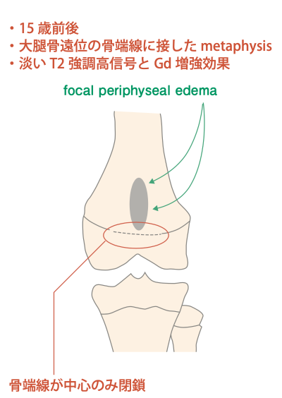 図6 focal periphyseal edema