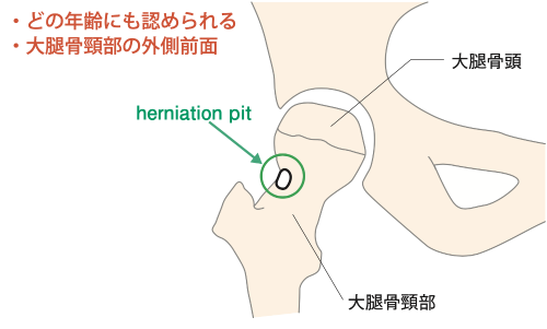 図7 herniation pit