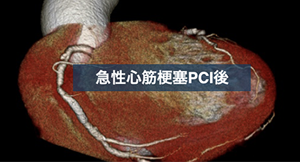 心臓CTにてステント再狭窄を指摘し得た急性心筋梗塞PCI後の1例