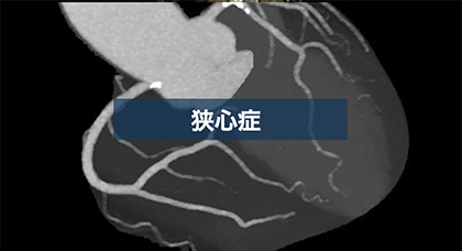 希釈TI法を用いた心臓CTの一例