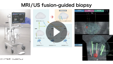 1. 前立腺癌に対するMRI/US fusion-guided biopsy「泌尿器科医の立場から」
