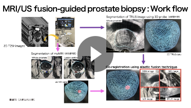 2. 前立腺癌に対するMRI/US fusion-guided biopsy「放射線科医の立場から」