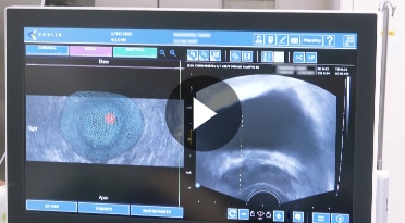 4. 前立腺癌に対するMRI/US fusion-guided biopsy 検査の流れ : 標的生検手技