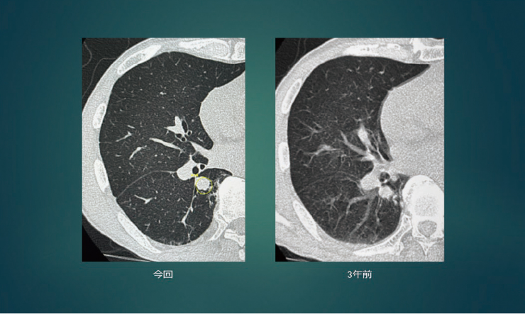 Plus.Lung.Nodule導入後初期経験　- AIを活用した胸部CT読影について-