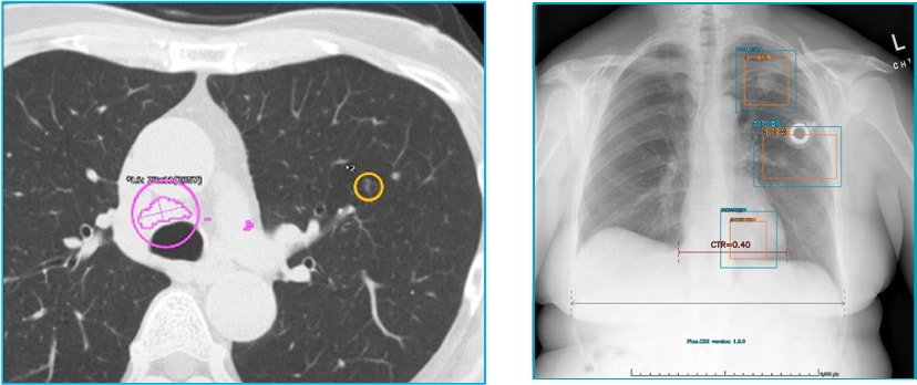 ROI表⽰機能を持つAIソフトウェア（左：Plus.Lung.Nodule、右：Plus.CXR）