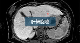 初回指摘から9ヶ月後に古典的肝細胞癌となった高度異型結節