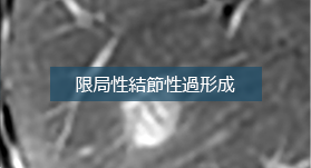 多血性肝腫瘤