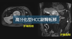 HCC術後フォローの有用性ー高分化型HCC副腎転移ー