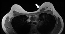 BPEがmildである浸潤性乳管癌（IDC）