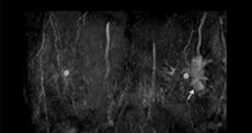 BPEがmildである非浸潤性乳管癌（DCIS)