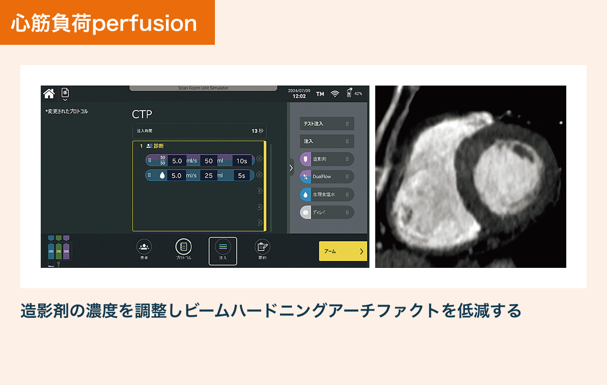 心筋負荷perfusionの撮影プロトコル