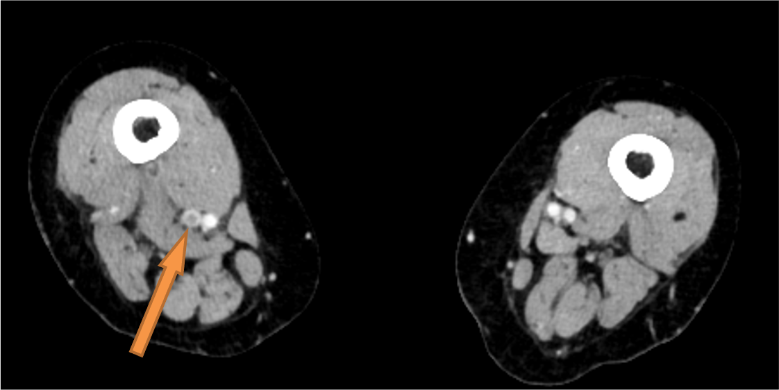 図2．造影CT　60keV　下肢静脈相