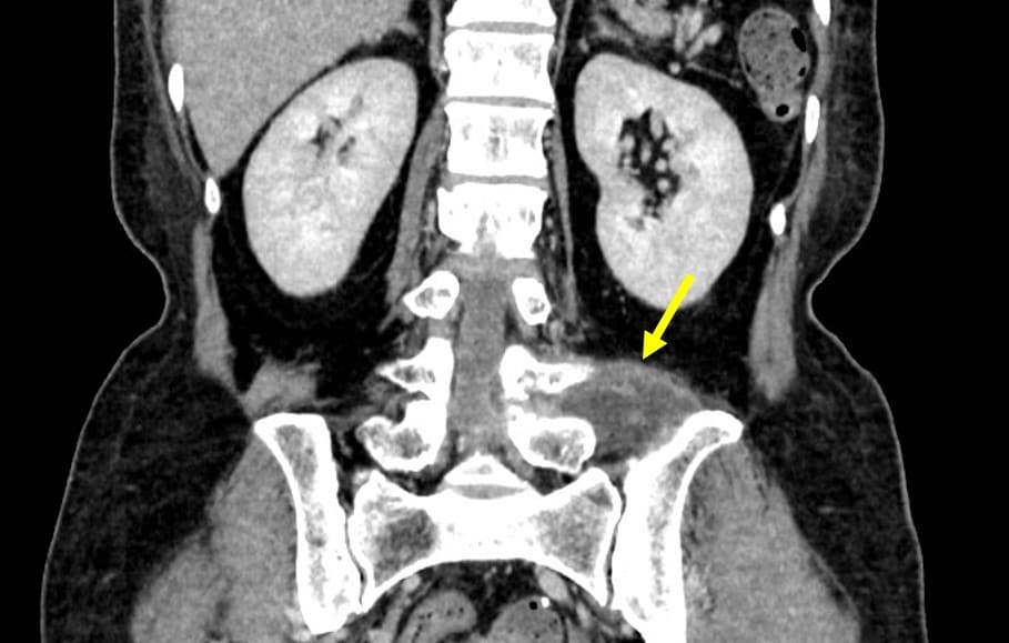 図3．平衡相（冠状断）