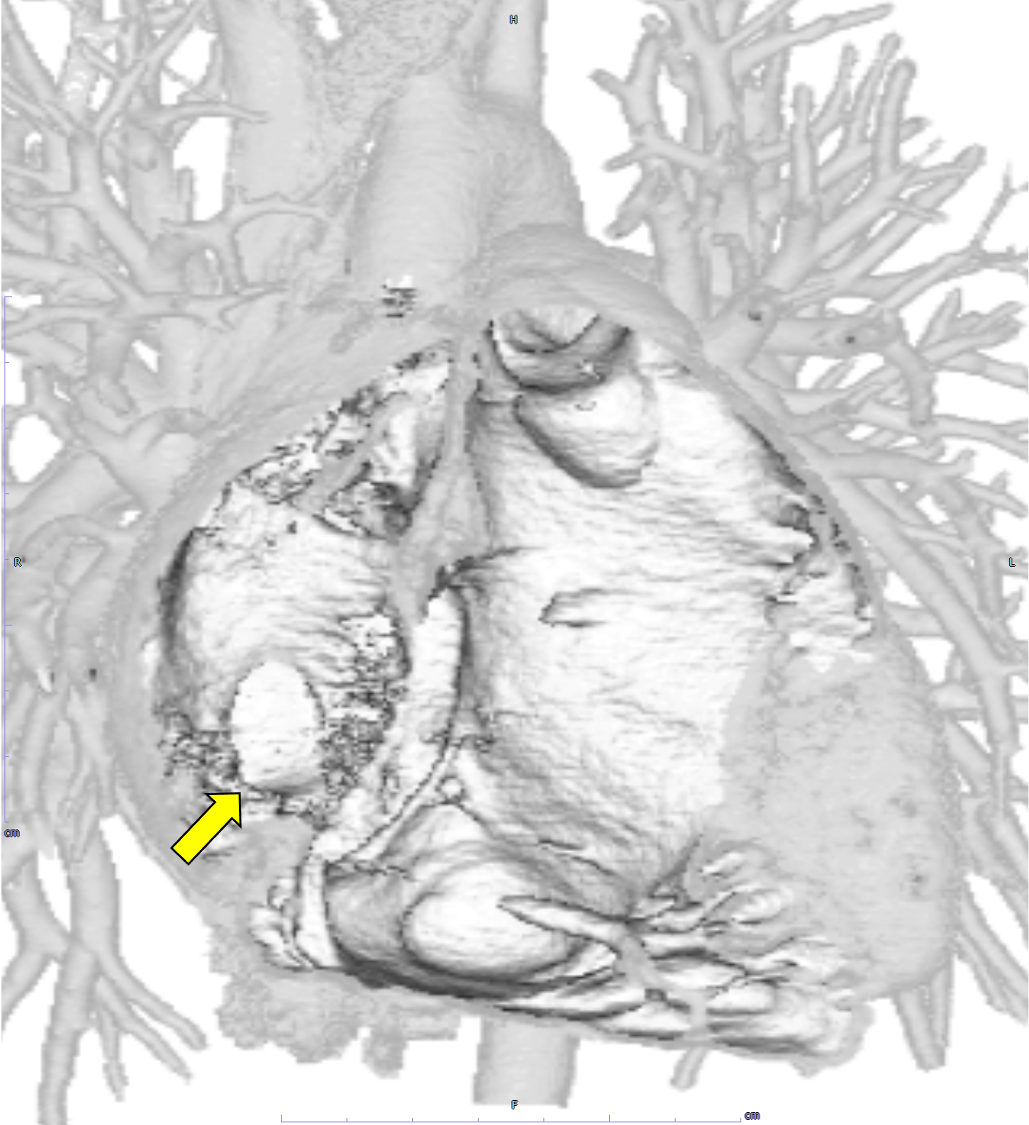 図4．心電図同期造影CTボリューム・レンダリング画像（動脈相）