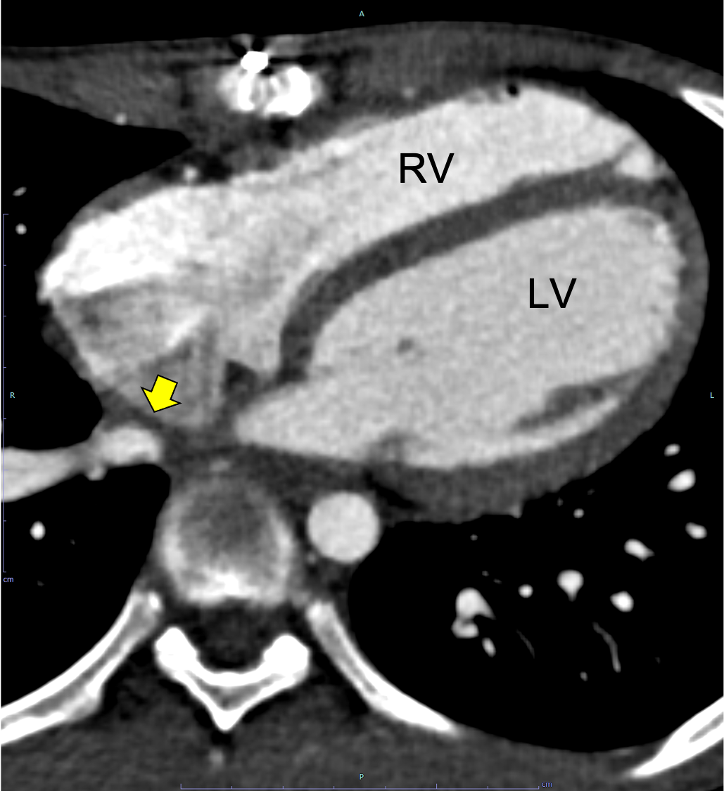 図5．心電図同期造影CT水平断（動脈相、外科的修復術後）