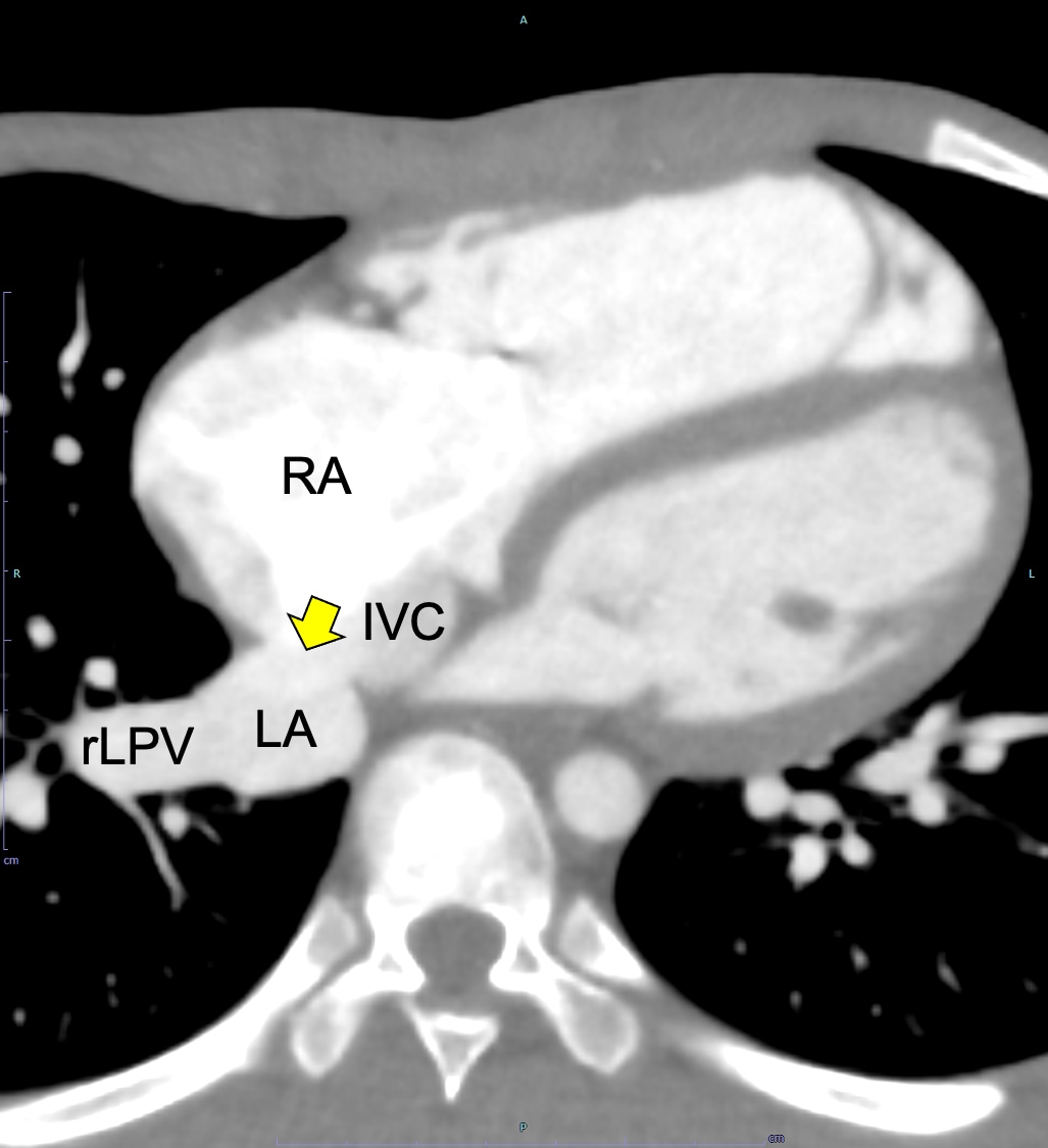 図１．心電図同期造影CT水平断（動脈相、欠損孔レベル）