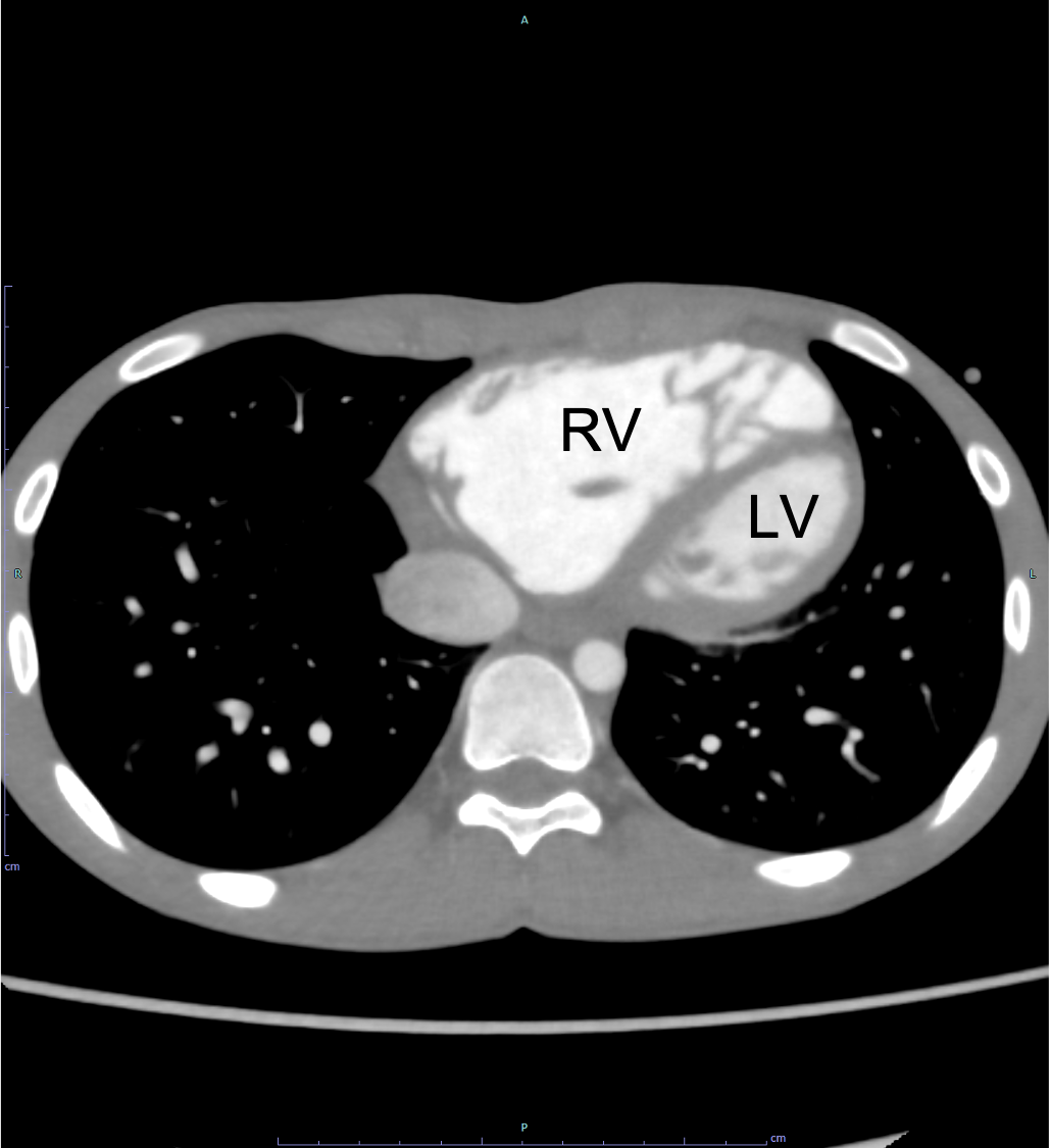 図2．心電図同期造影CT水平断（動脈相、心尖部レベル）