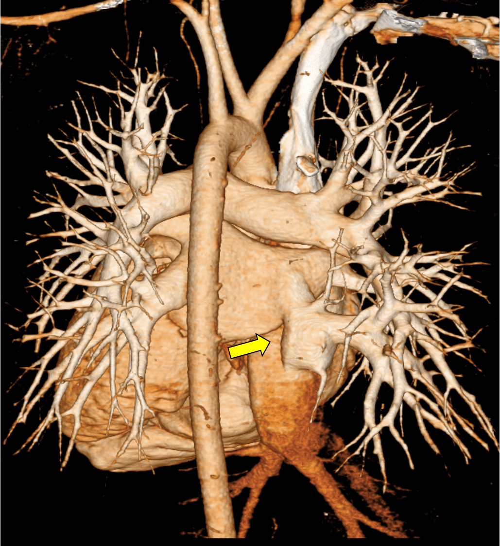 図3．心電図同期造影CTボリューム・レンダリング画像（動脈相）