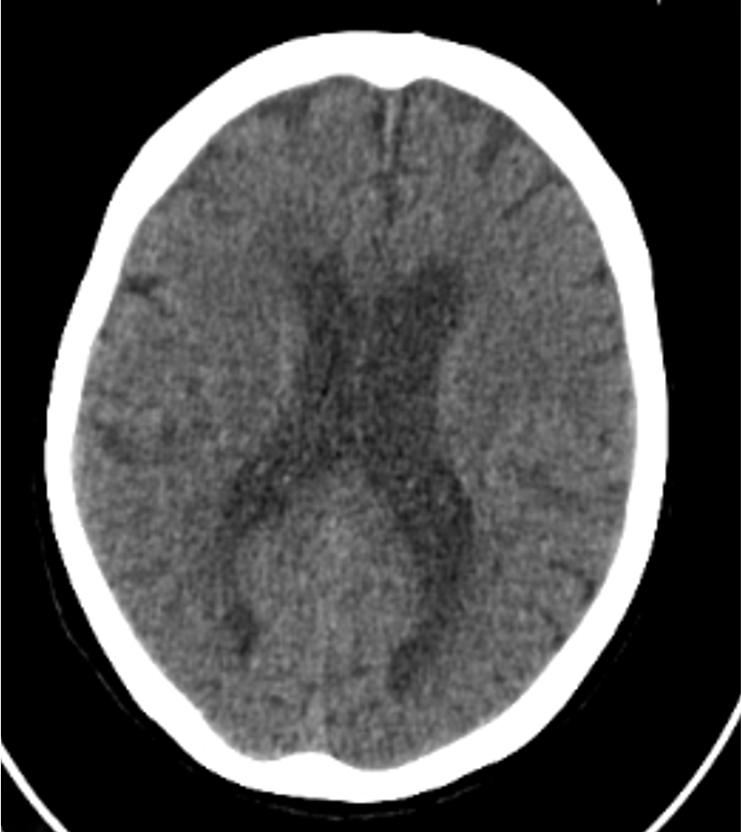 図１．頭部単純CT