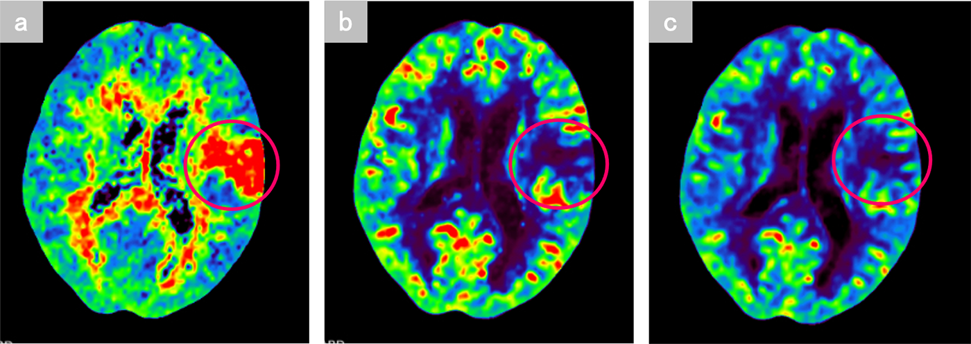 図2．Perfusion CT (a) MMT, (b) CBF, (c) CBV