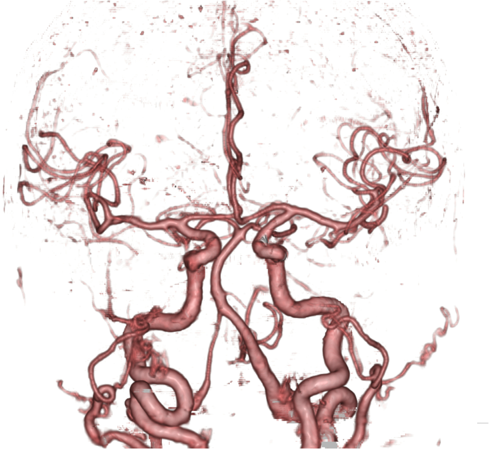 図3．頭部CT Angiography